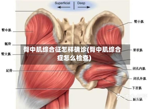 臀中肌综合征怎样确诊(臀中肌综合症怎么检查)-第2张图片