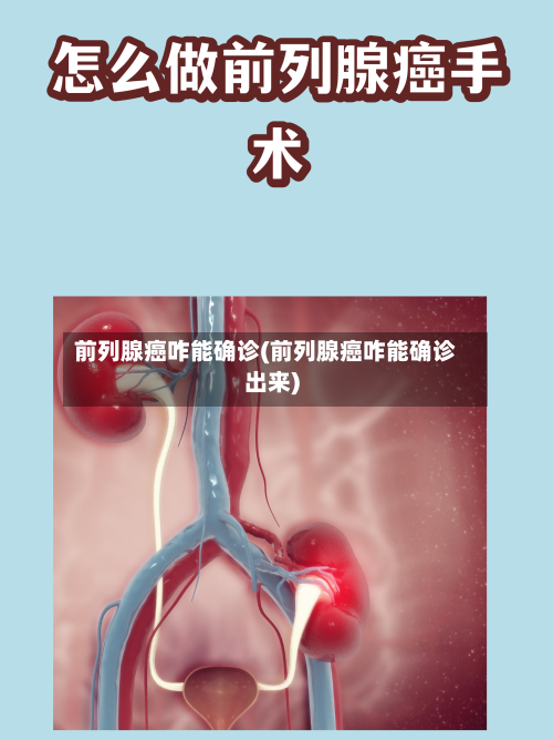 前列腺癌咋能确诊(前列腺癌咋能确诊出来)-第3张图片