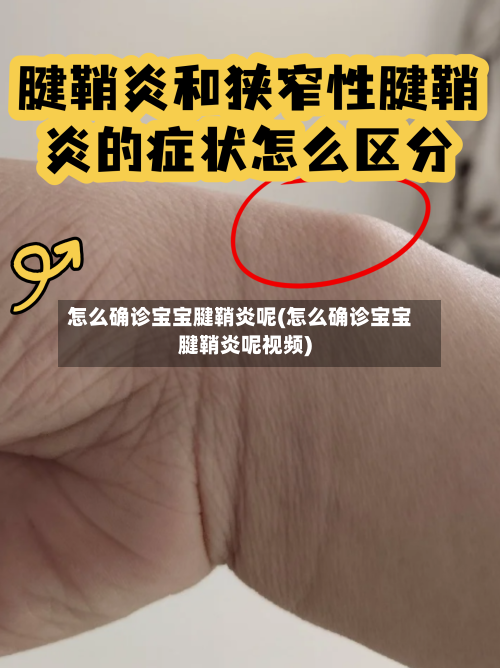 怎么确诊宝宝腱鞘炎呢(怎么确诊宝宝腱鞘炎呢视频)-第3张图片