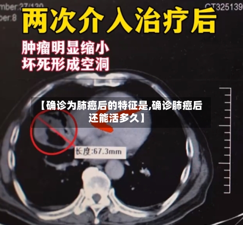 【确诊为肺癌后的特征是,确诊肺癌后还能活多久】