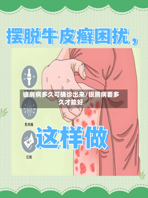 银屑病多久可确诊出来/银屑病要多久才能好