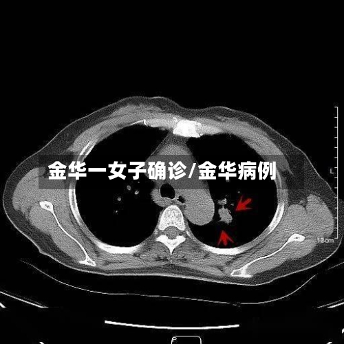 金华一女子确诊/金华病例