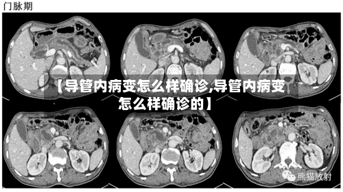 【导管内病变怎么样确诊,导管内病变怎么样确诊的】