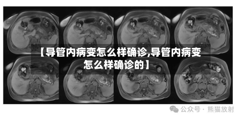 【导管内病变怎么样确诊,导管内病变怎么样确诊的】-第3张图片
