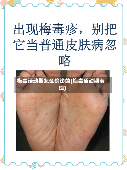 梅毒活动期怎么确诊的(梅毒活动期表现)-第3张图片