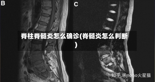 脊柱脊髓炎怎么确诊(脊髓炎怎么判断)