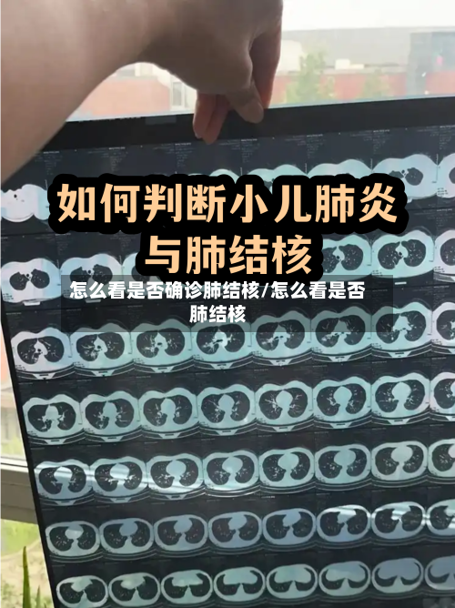 怎么看是否确诊肺结核/怎么看是否肺结核