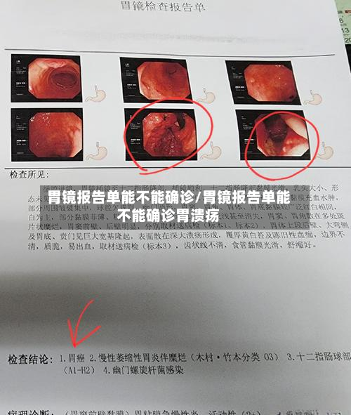 胃镜报告单能不能确诊/胃镜报告单能不能确诊胃溃疡