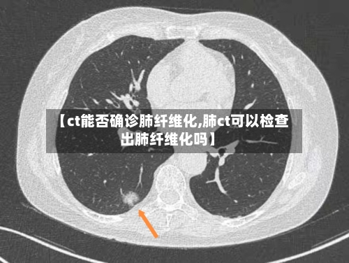 【ct能否确诊肺纤维化,肺ct可以检查出肺纤维化吗】-第2张图片