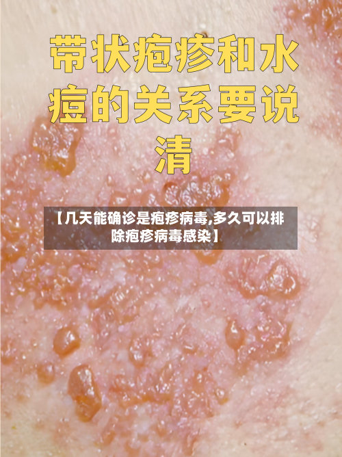 【几天能确诊是疱疹病毒,多久可以排除疱疹病毒感染】-第2张图片