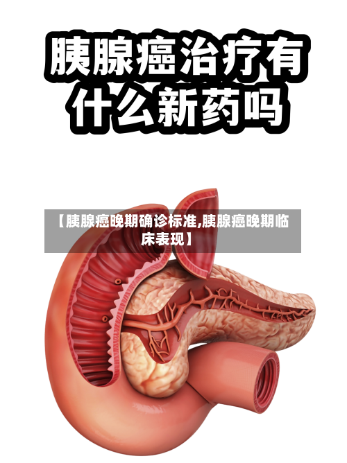 【胰腺癌晚期确诊标准,胰腺癌晚期临床表现】-第2张图片