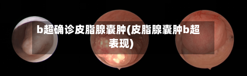 b超确诊皮脂腺囊肿(皮脂腺囊肿b超表现)-第2张图片