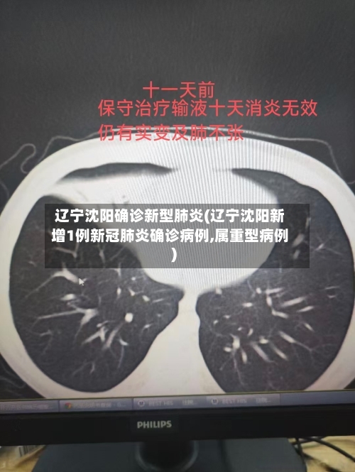 辽宁沈阳确诊新型肺炎(辽宁沈阳新增1例新冠肺炎确诊病例,属重型病例)-第2张图片